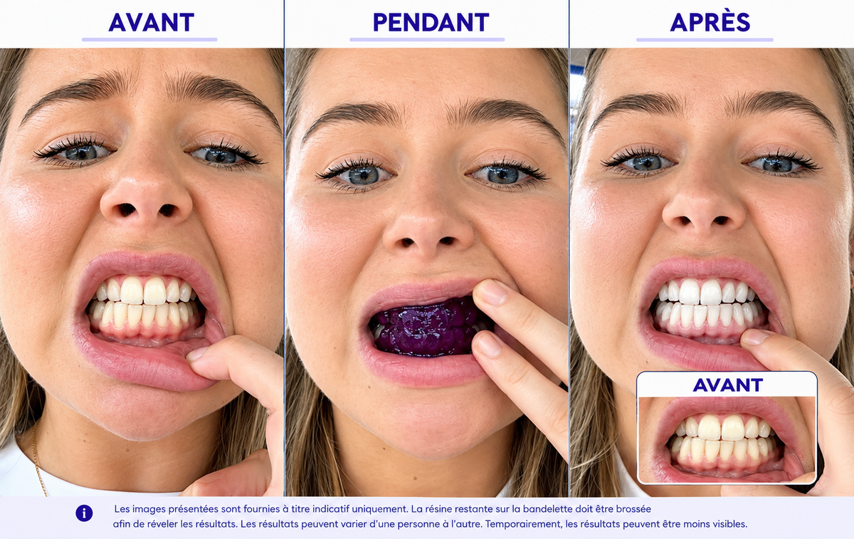 Bandes Dentaires Violettes — Correcteur de Teinte, Sourire Éclatant (7 soins)