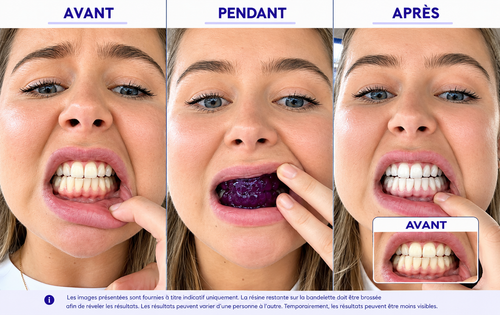 Bandes Dentaires Violettes — Correcteur de Teinte, Sourire Éclatant (7 soins)