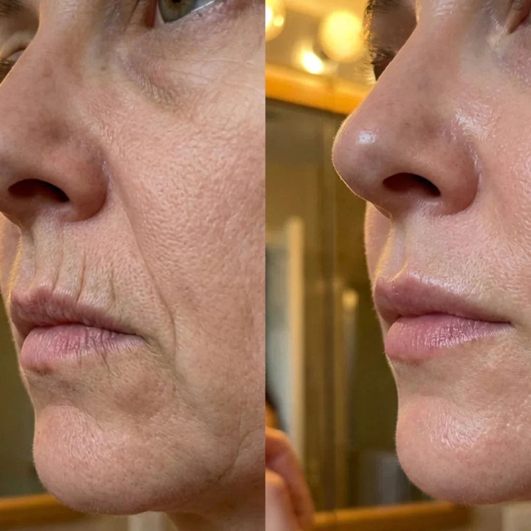 Baume collagène & PDRN — comparaison avant / après sur les rides du visage