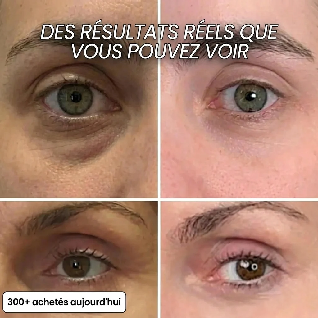 Baume collagène & PDRN — avant / après sur le contour des yeux