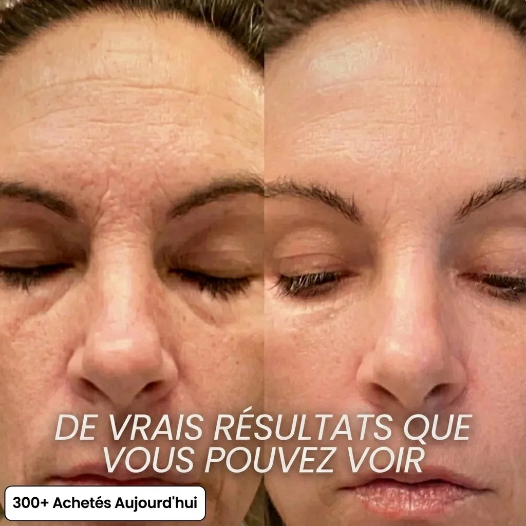 Baume coréen collagène — avant / après sur les rides du front et des yeux